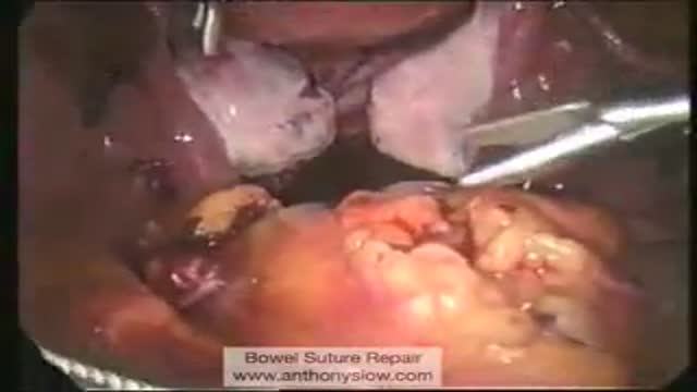 ⁣Laparoscopic Suture Repair of Bowel