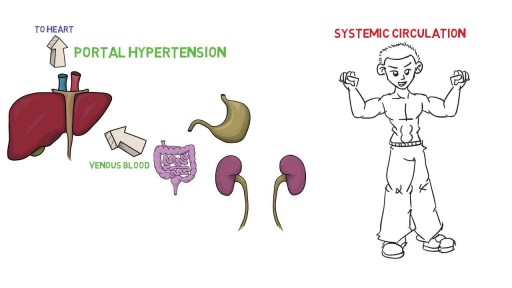 ⁣Portal Hypertension Pathophysiology