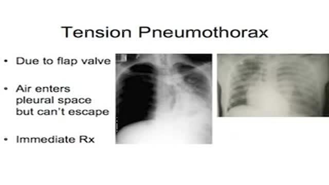 Intercostal Tube Insertion