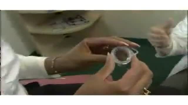 Cervical Cap for Birth Control