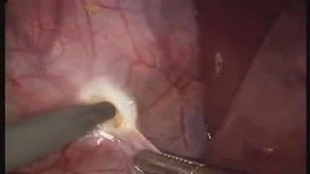 Laparoscopic Right Adrenalectomy