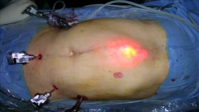 Laparoscopic repair of Incisional Hernia