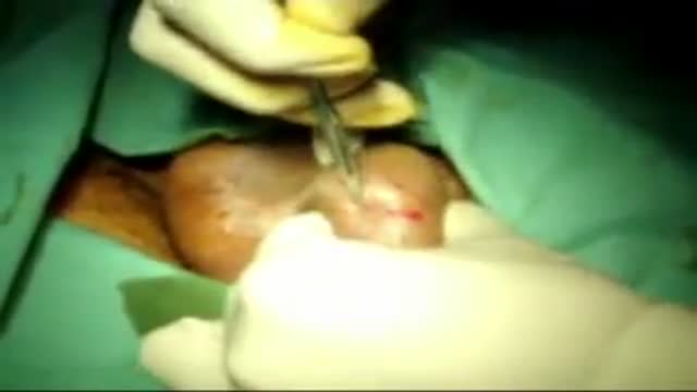 Testicular Biopsy for ICSI