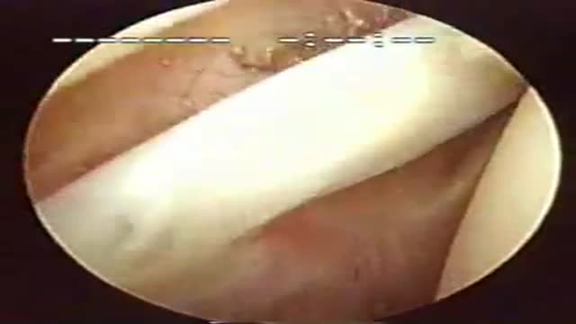 Arthroscopic Shoulder Surgery