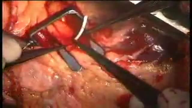 beating heart surgery