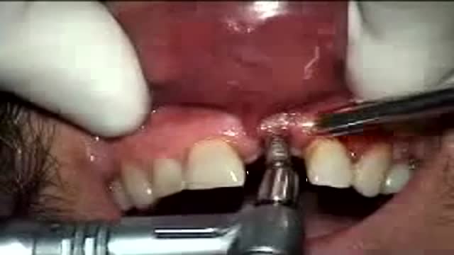 Dental Implant Tooth failure