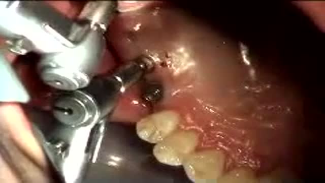 Implant failure