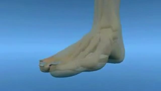 ⁣Bunion Hallux Abductor Valgus Surgery