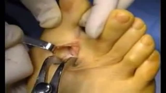 Hallux Valgus Pedis surgery