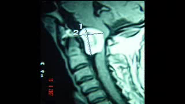 Foramen Magnum Neurofibroma