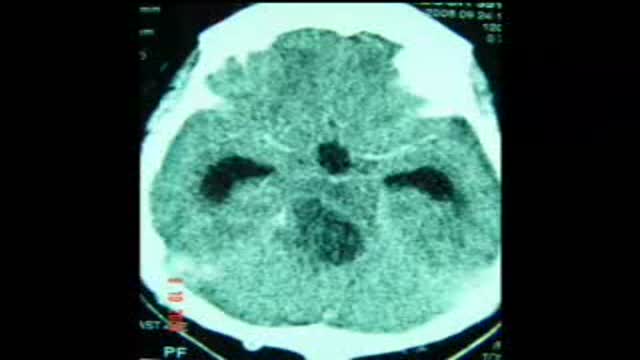 ⁣Brain Stem Tumor Operation