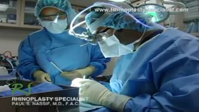 Rhinoplasty Surgical Procedures - Columella Strut Placement