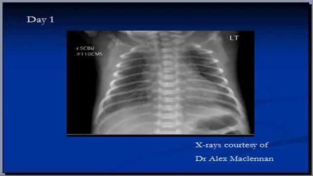 Chest x-ray interpretation, RDS