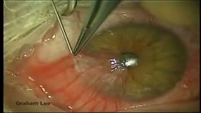 ⁣Pterygium Surgery with Auto-Conjunctival Graft