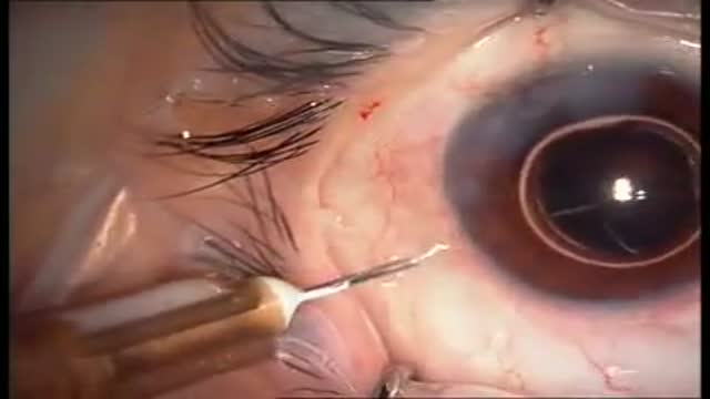 Intravitreal TSA injection