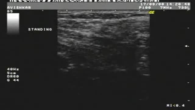 Spigelian Hernia on Ultrasound