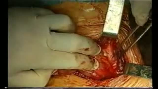 Total Thyroidectomy