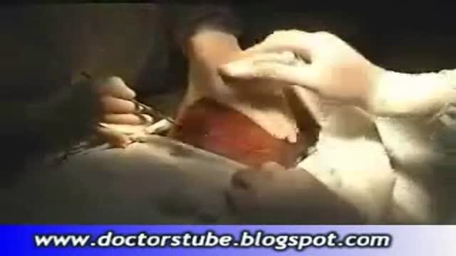 Subtotal Thyroidectomy