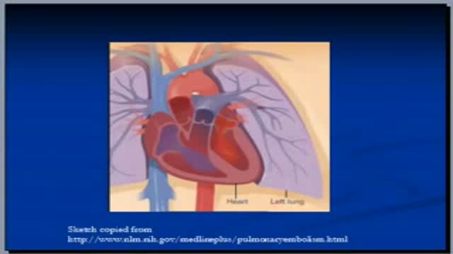 Chest, Pulmonary Embolism