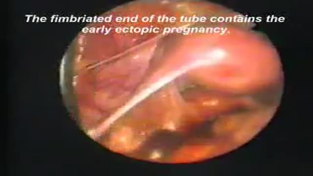 ⁣Tubal Pregnancy - Lapaoscopic Removal