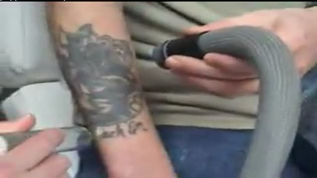 Tattoo Removal Video