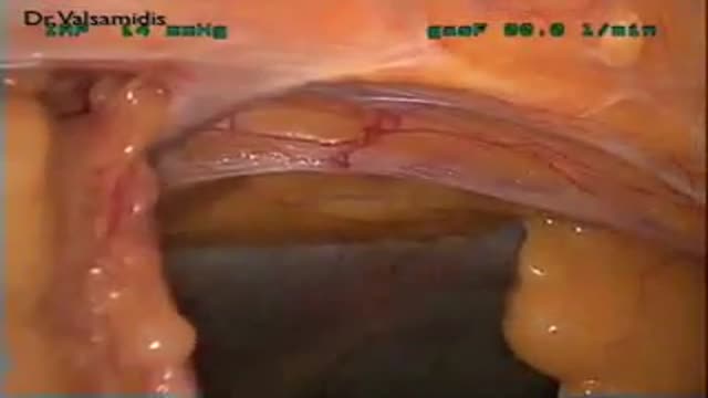 Laparoscopic treatment of a large Umbilical Hernia in an obese patient.