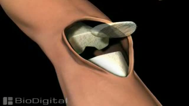 3D Knee Replacement Surgery