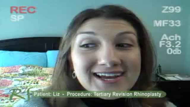Patient Experience Having Revision Rhinoplasty Performed by Dr. Paul S. Nassif