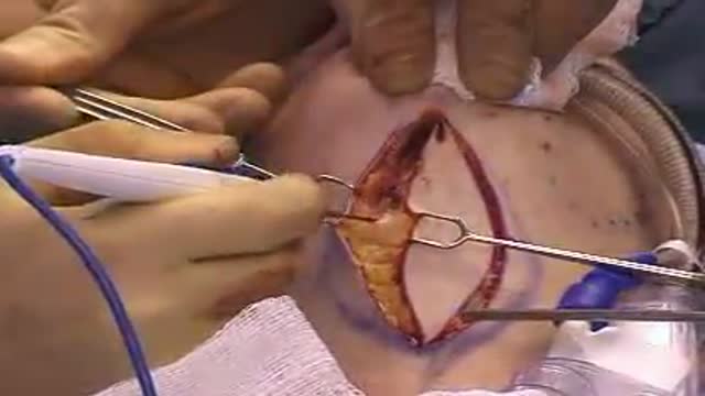 Direct Excision Cervicoplasty