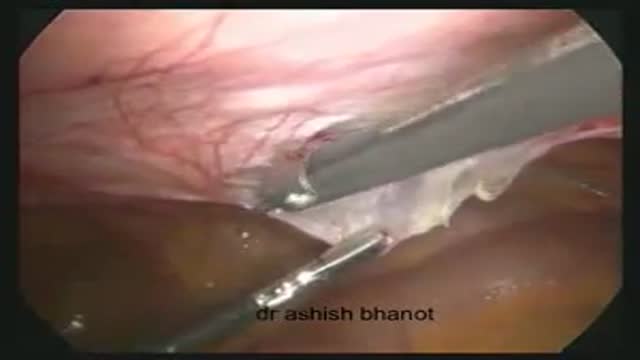 ⁣Laparoscopic transabdominal preperitoneal hernia repair for direct inguinal Hernia