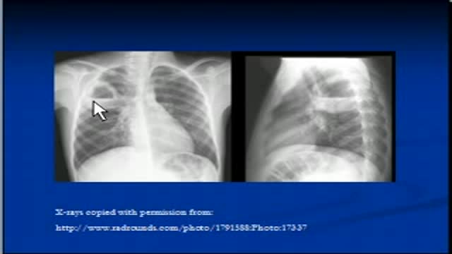 Chest x-ray Interpretation -Cavitating lesions