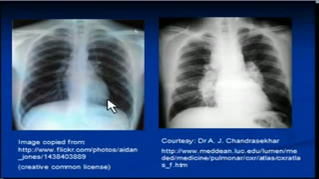 ⁣Chest x-ray interpretation -Sarcoidosis