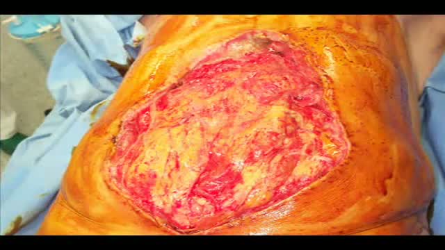 Laparostomy Surgical Closure