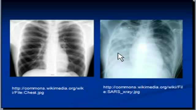 Chest x-ray -- Lung consolidation