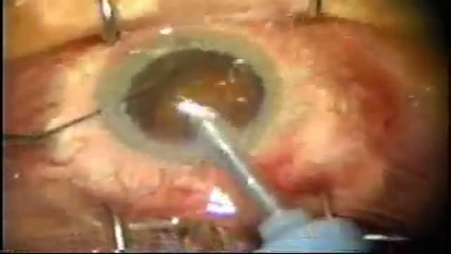 ⁣Cataract Video