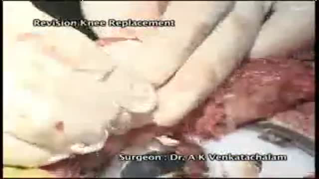 Revision knee replacement 4