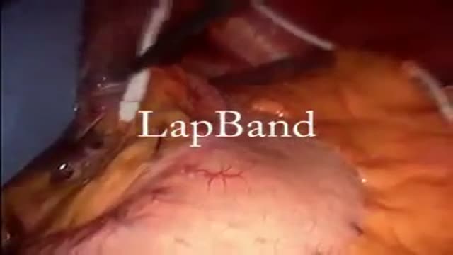 Mini Gastric ByPass after Lap Band Removal