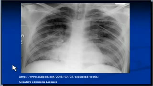 ⁣Chest x-ray interpretation showing Tubes and lines