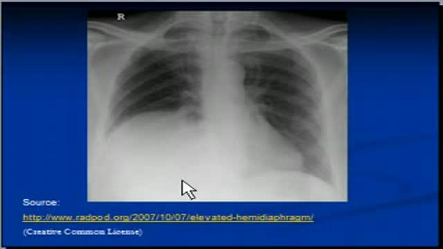 ⁣Chest x-ray -- Raised Hemidiaphragm