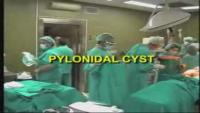 LASER SURGERY Pilonidal Cyst removal