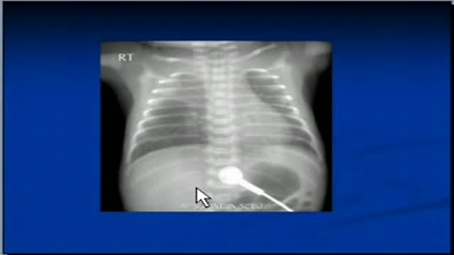 ⁣Chest x-ray interpretation --ET tube position