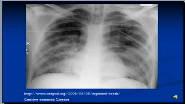 ⁣Chest x-ray interpretation -- Tubes and lines