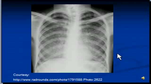 ⁣Chest x-ray interpretation-- Miliary Tuberculosis