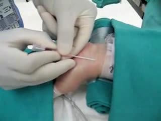 ⁣Arterial Line Insertion