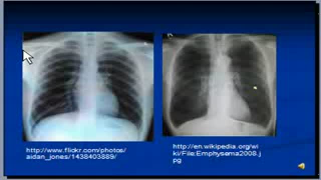 ⁣Chest x-ray interpretation -- COPD and Emphysema