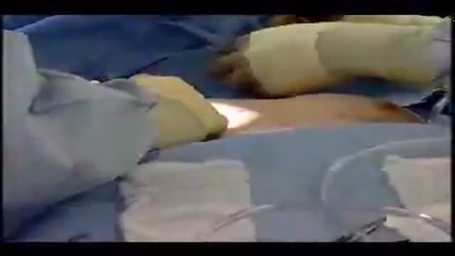 ⁣Breast Augmentation Plastic Surgery Video