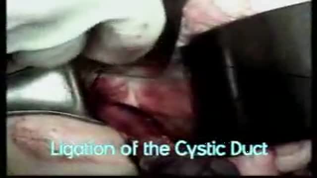 ⁣Open Cholecystectomy