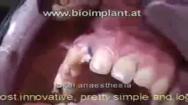 SENSATIONAL: IMPLANT WITHOUT DRILLING AND ABSOLUTE FLAPLESS IN JUST 4 MINUTES. LIVE VIDEO !