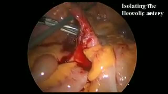 Laparoscopic Unexpected Complication