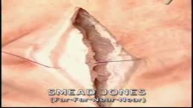 ⁣Smead Jones Sutures - Far Far- Near Near